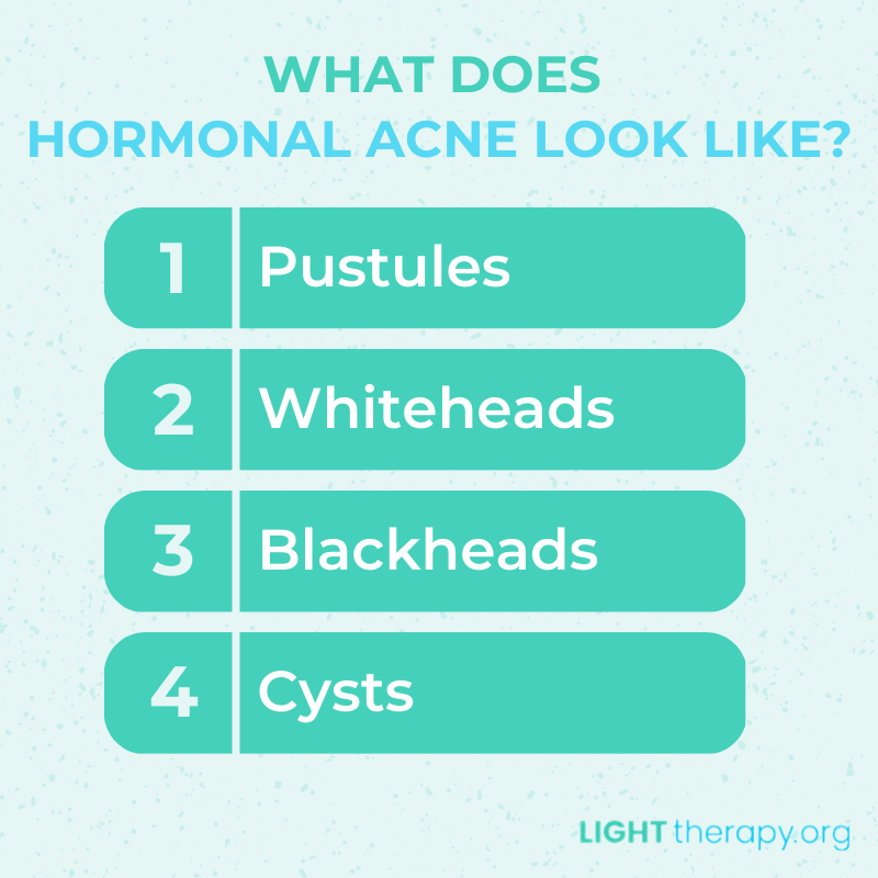 Infographic: How Light Therapy Helps Hormonal Acne